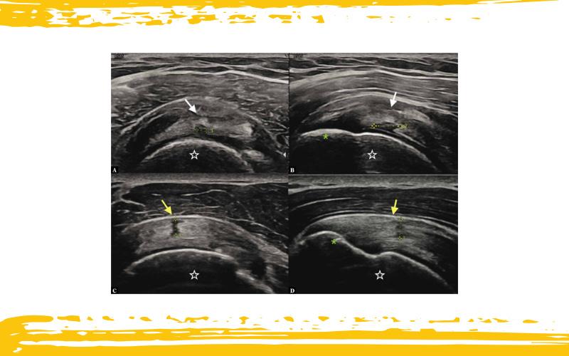 Manguito rotador tempo formacion 1.jpg